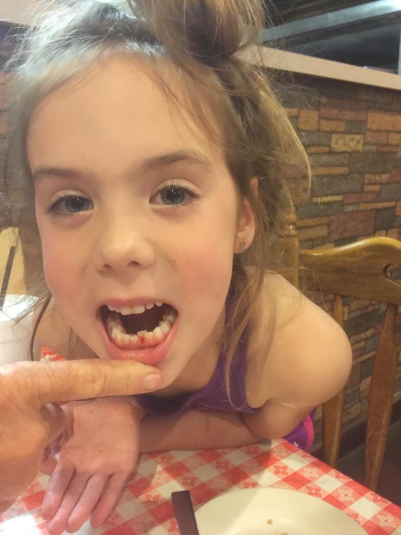 Brothers knocked out Lexi 2nd tooth today
