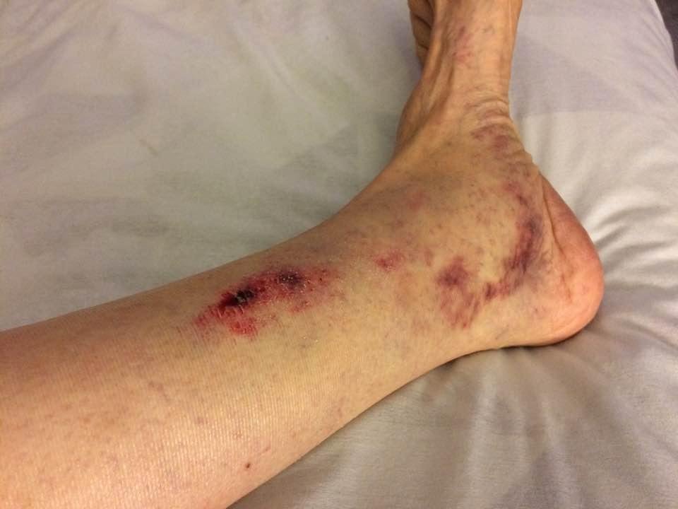 This is what you get when you do something stupid. I did! One week ago yesterday.