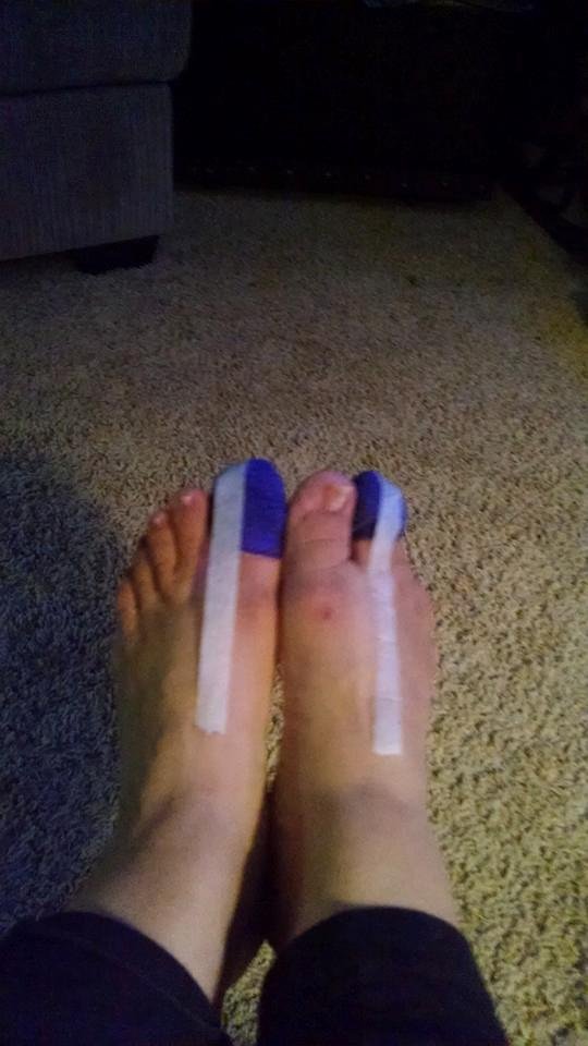 Well the ingrown toes are supposedly fixed.......I went in for a consult and came out like this.....I love the purple bandage but they didn't have colored tape at the grocery store......