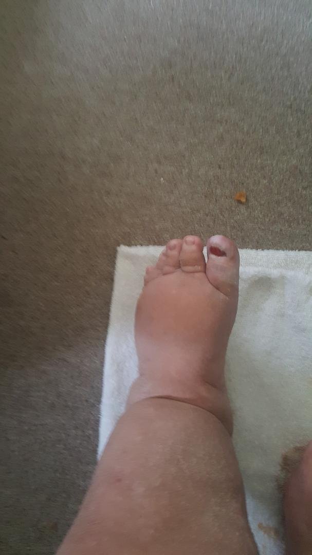 2 days post op after toenail removal