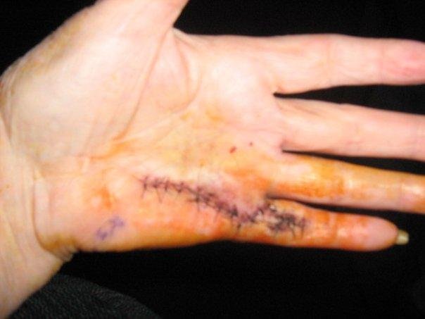 A BETTER VIEW OF THE STITCHES.
