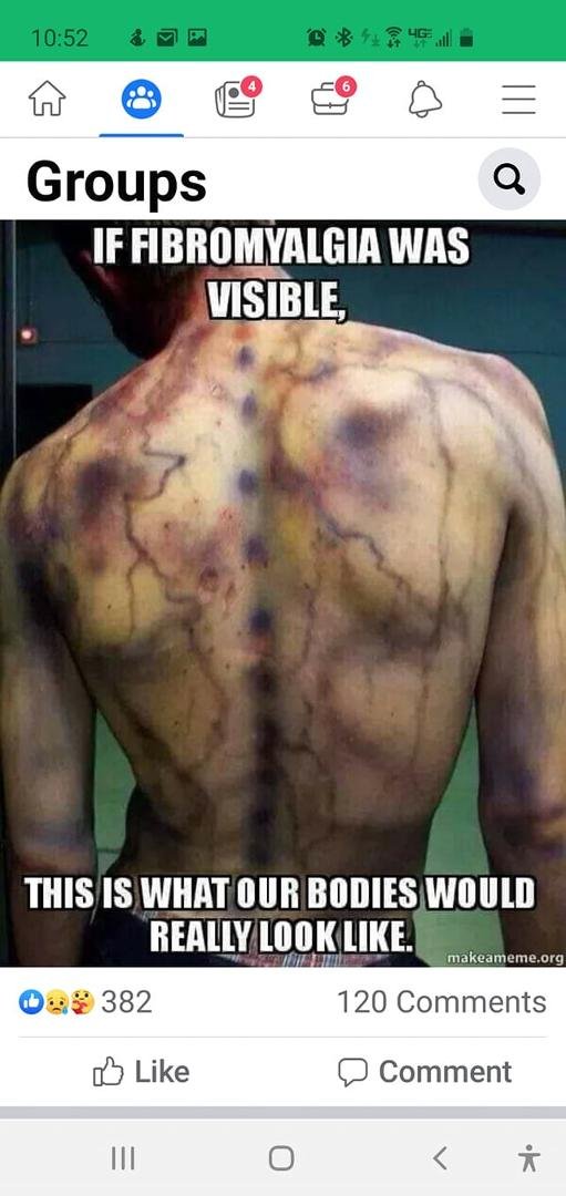 Finally a picture of pain if fibromyalgia was visible!!!