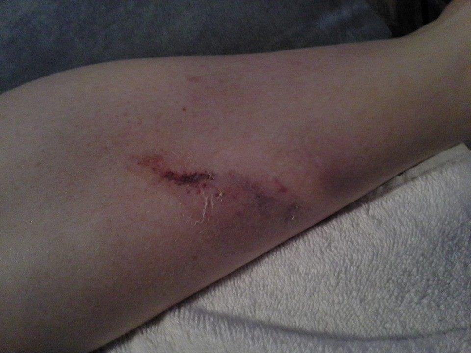 The birthday girl Jenna Collins Heidi Collins and i going for a girls day spa outing and Jenna slips down our wet steps onto her shin:(
Reschedule time!
My poor baby!