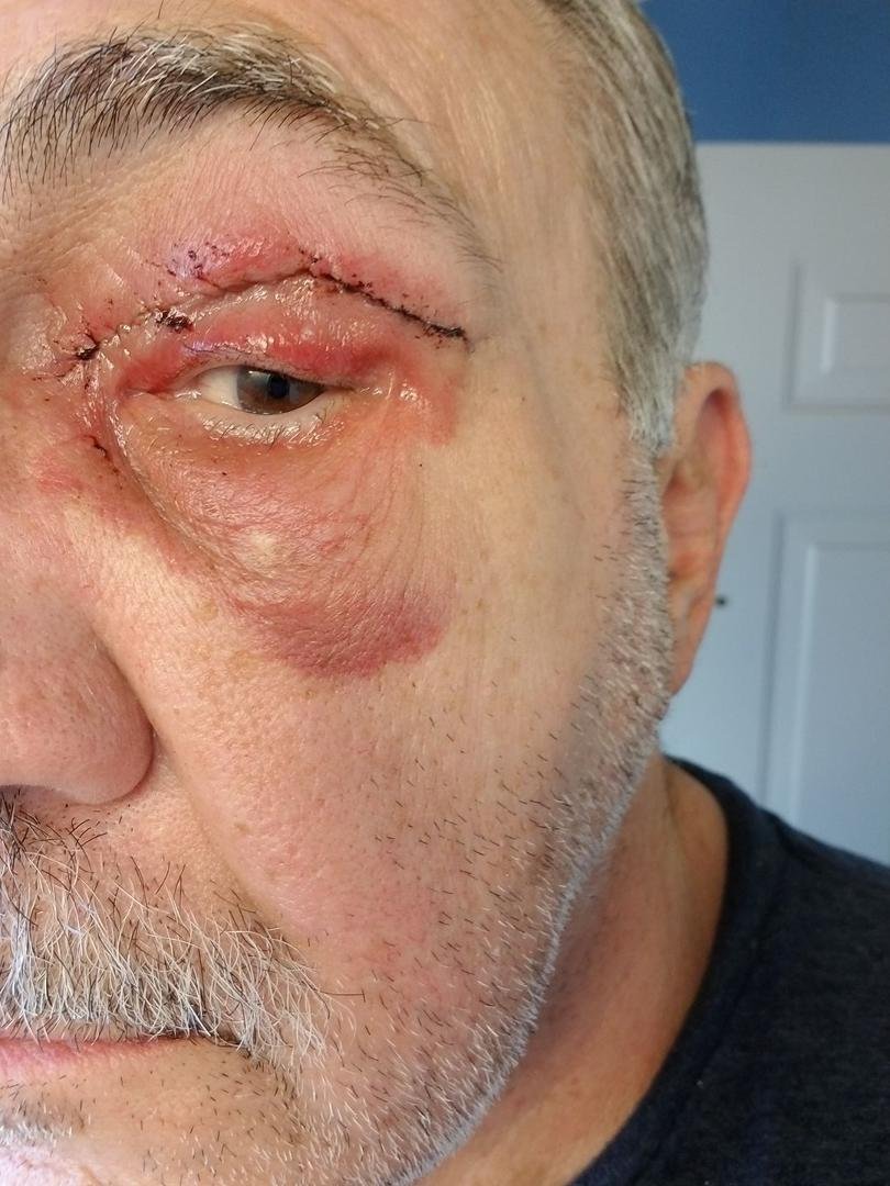 No more droopy eyelids!