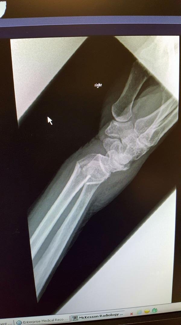 Here's my poor wrist. Could have been worse.