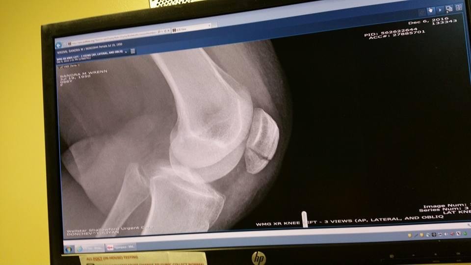 Great broken knee cap. Fell this morning. Need surgery