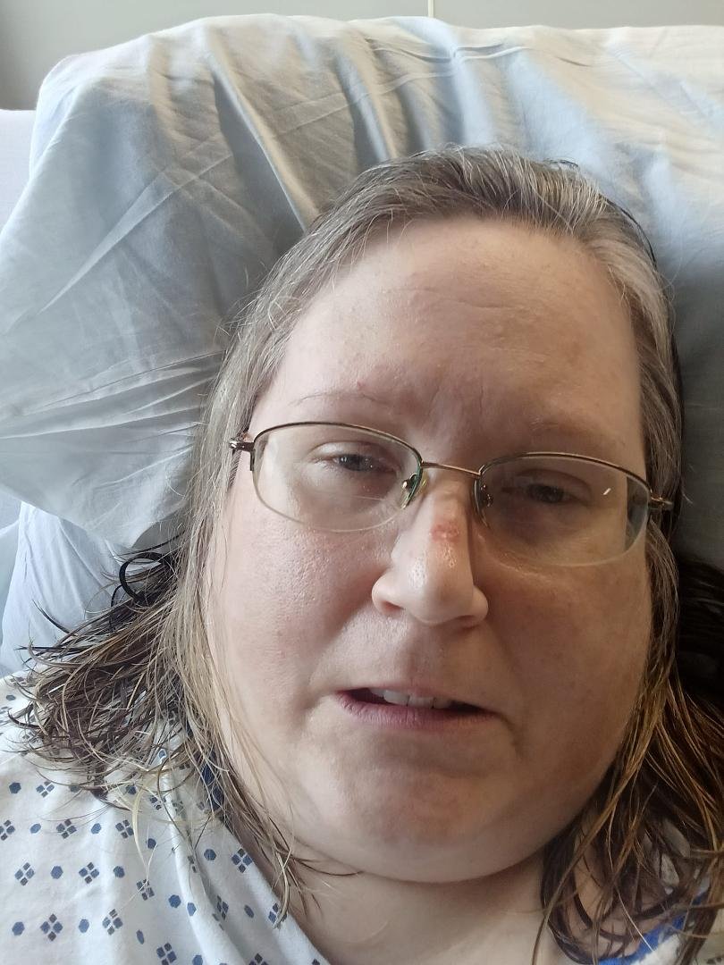 Second post op day of second round with my appendix