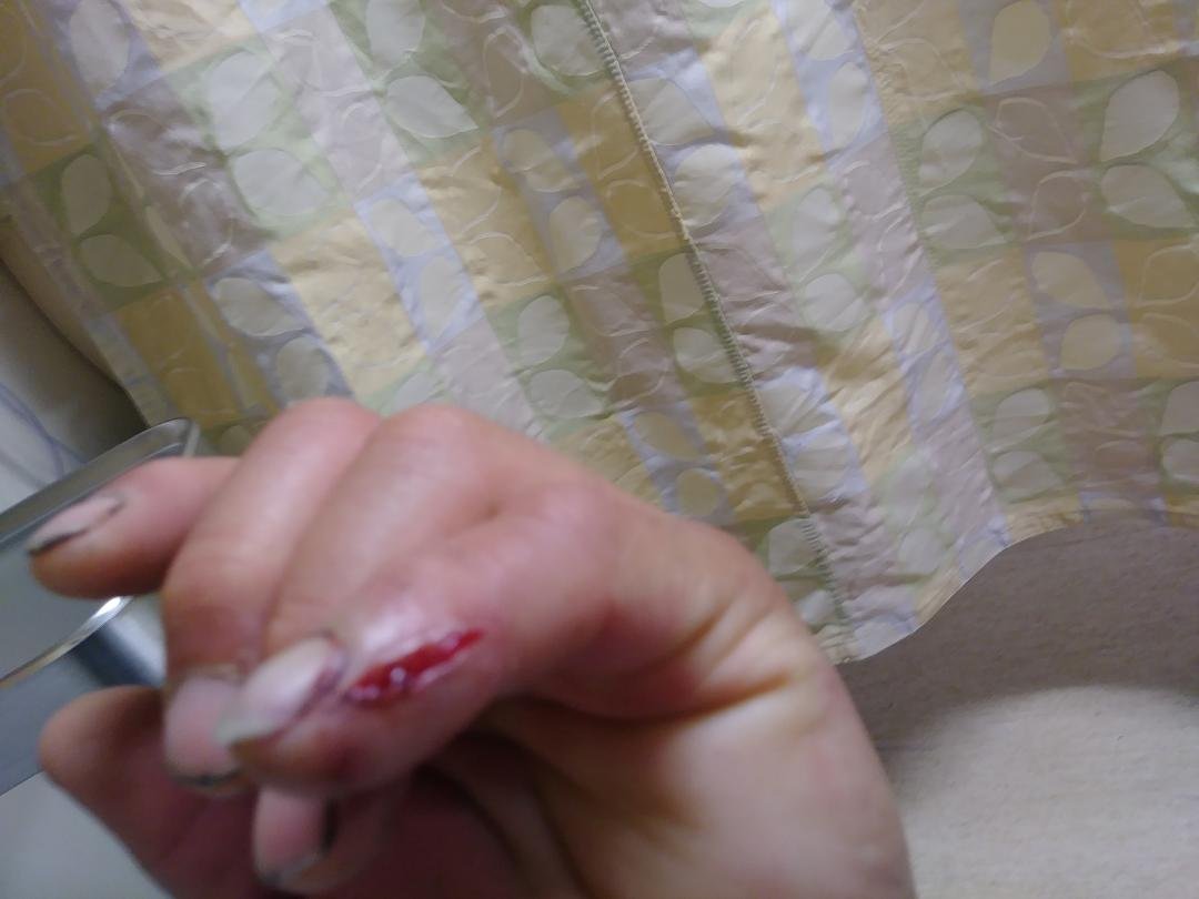 Im at St Johns hospital smashed my pinky finger and yes it hurts alot I just dont show the pain
