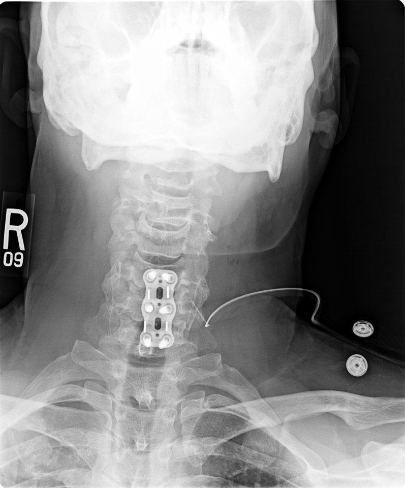 Warren Hall's album, Surgery