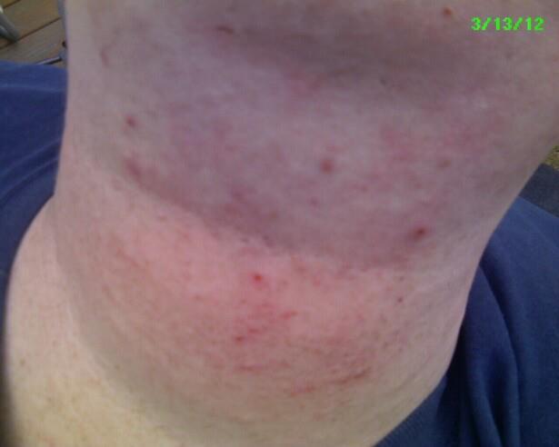 shaving ouchies