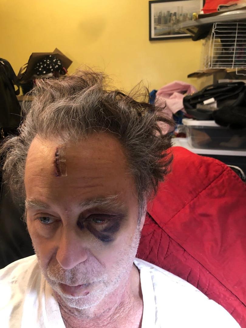Got knocked down the subway stairs last Saturday... F...ed me uo 2 skull factures and my eye orbit cracked.