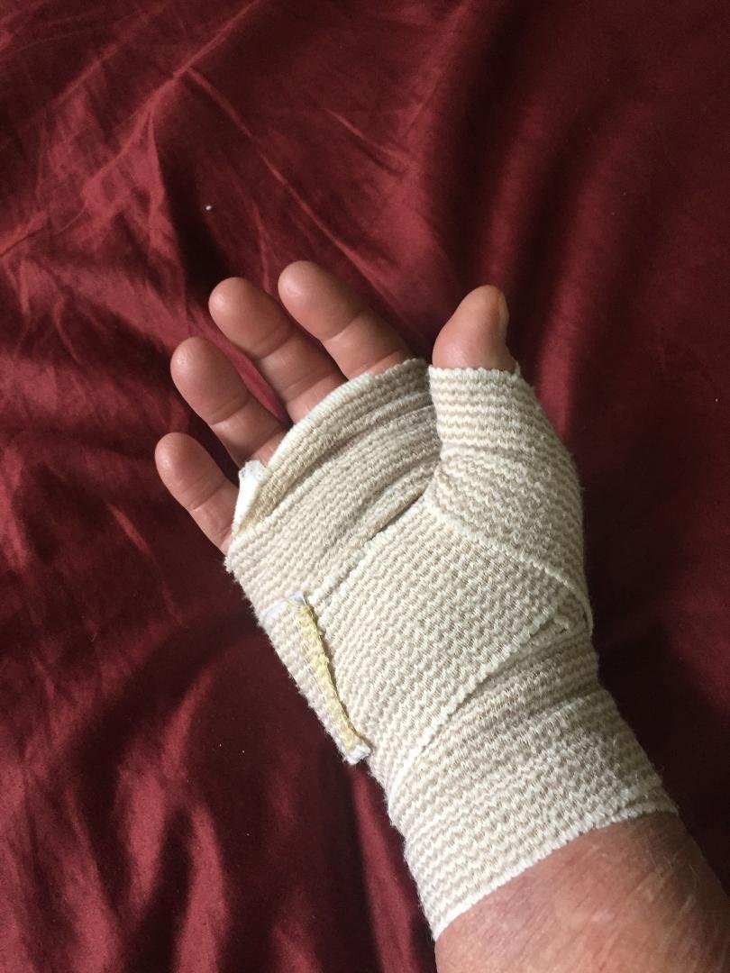 Second time only fingers 1 and 2 plus wrist carpal tunnel