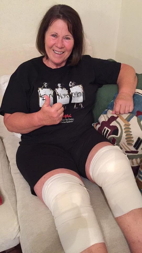 Thanks soooo much everyone for your prayers & well wishes❣ The surgery was a little more extensive than originally thought(both meniscus on both knees torn, plus some"clean up"),so I spent the night in the hospital. I woke