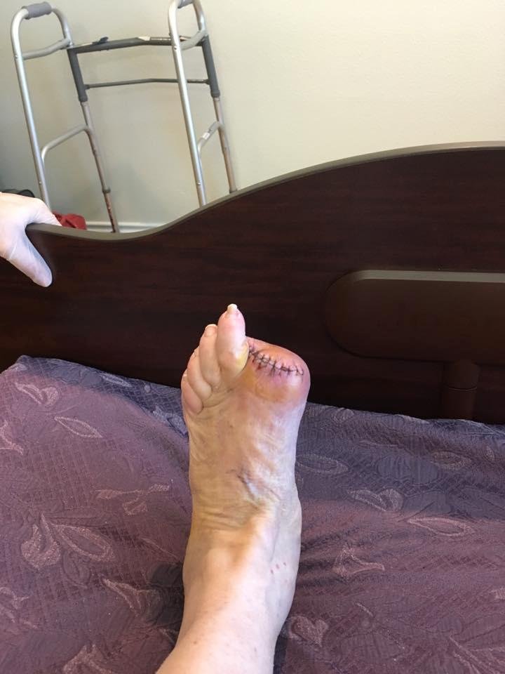This what happens when Diabetes takes over your foot! Trying to stopping it before it takes over my body. We started with partial removal, but would not heal. Had the leg veins roto rootered to get circulation to my foot.