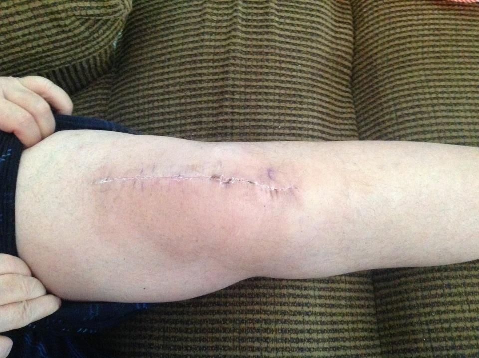 This my knee after surgery still really sore