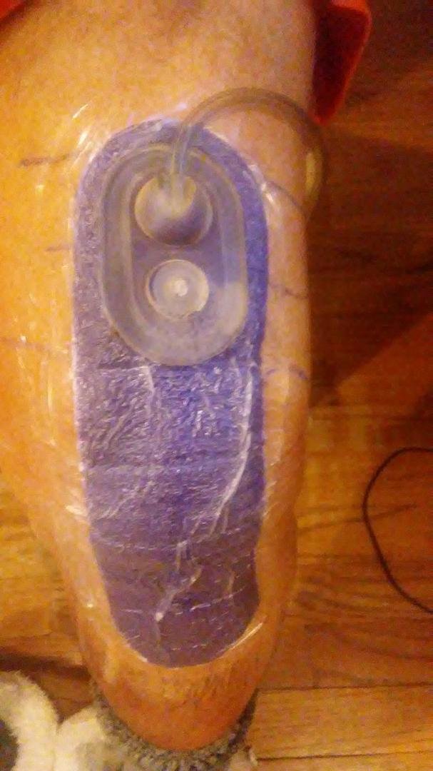 Back at home after left knee replacement....glad I only have 2 knees. I don't think I could go through this 3 times.😷😫😓