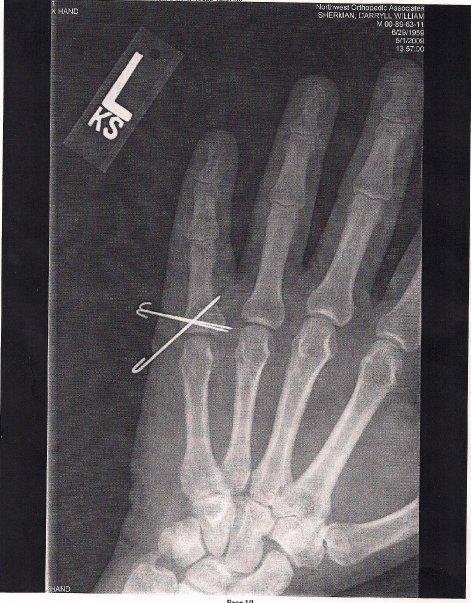X-ray showihng pins