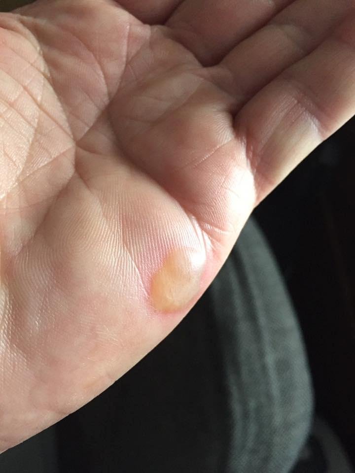 I burned my hand yesterday, while my mom was burning trash!