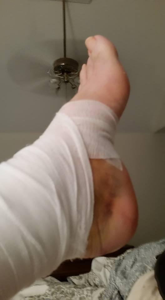 Still pretty bruised and in dire need of a pedi, but coming along slowly but surely!