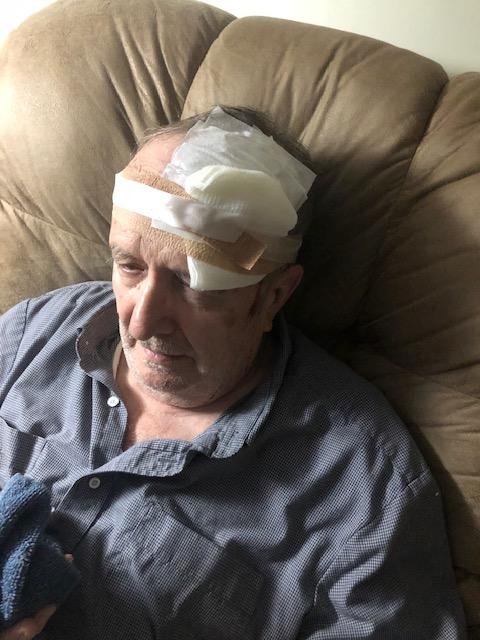 Had my second bout with cancer cells and had them removed. Not as bad as it looks.