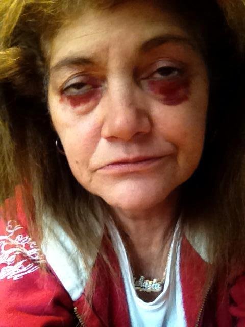 My eyes are looking better, compared to 2 days ago. Today is a week that I had the surgery. I'm going crazy, it feels as if the knot for the stitches  is rubbing against  the back  off my eyes, & all the eye drops. You can'