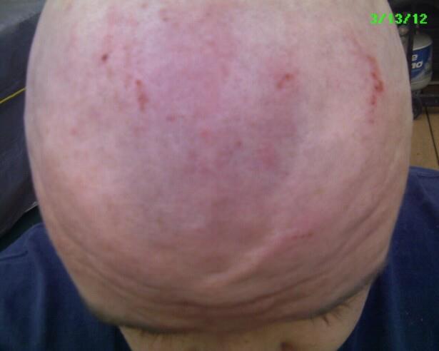 more shaving ouchies