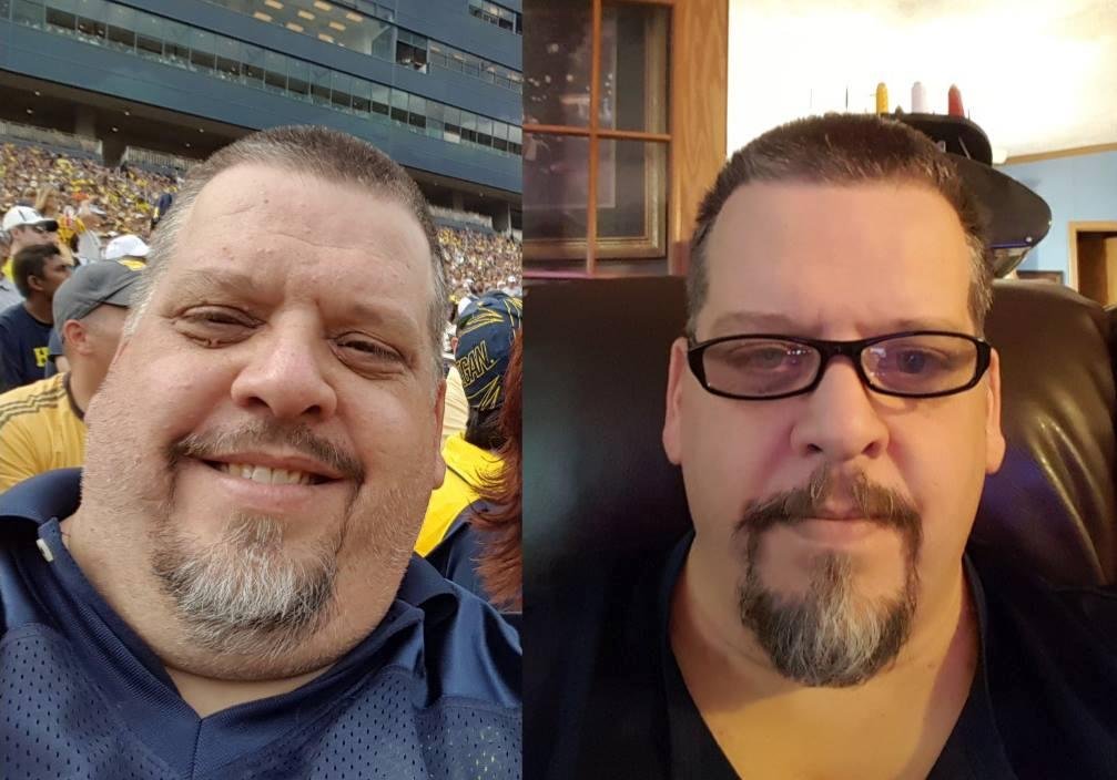 Four weeks ago I had surgery, I have lost 50 lbs in the last 6 wks. I am already down 70lb from my high weigh this year. Thanks for all the support. The pic on the left was 2 days before surgery.