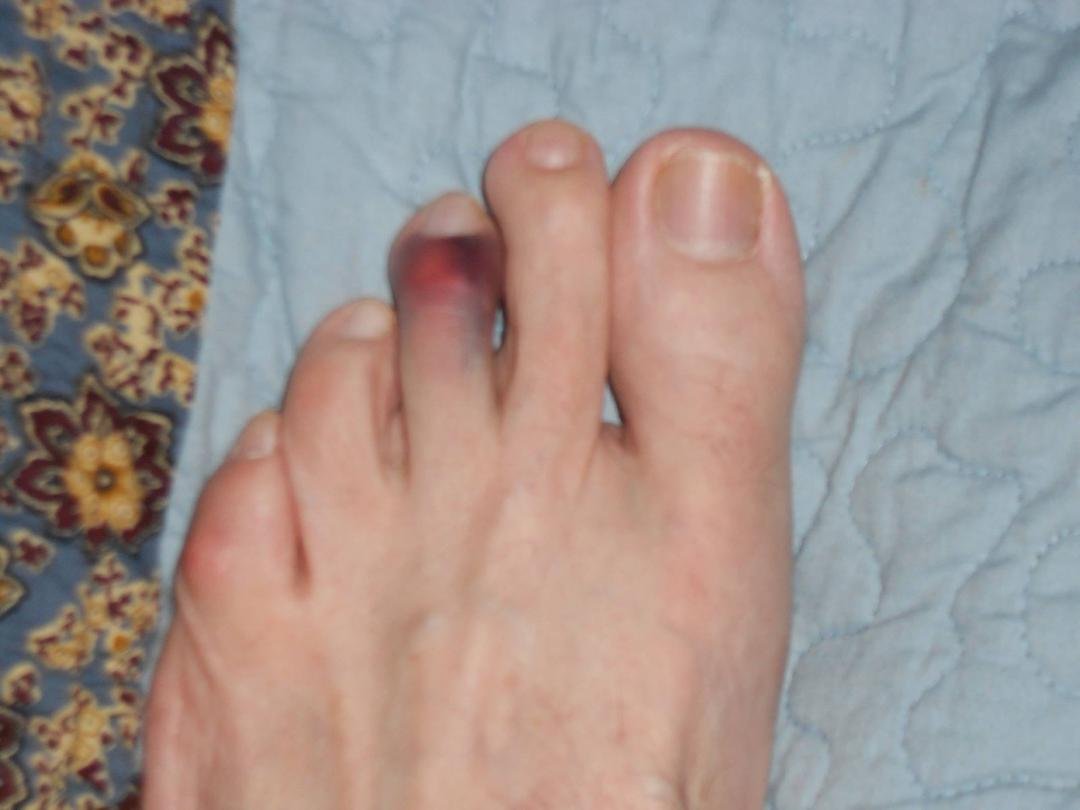 Earlier this morning, my left foot middle toe took on the bar stool. Reportedly "STRH" was heard, numerous times. Guess what won,  
Well... Bye! :(