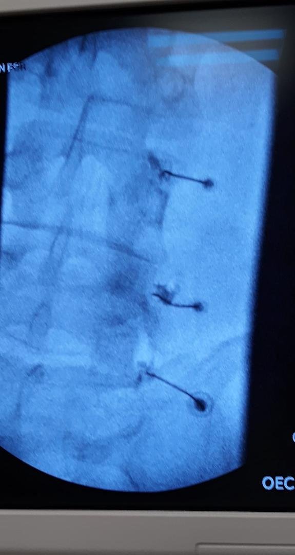 For those of you that don't know what it looks like to have 3 long needles in your back here it is.