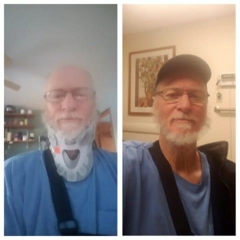 Neck brace is gone. All broken bones in chest and neck are healed. Got to see pics of elbow and knee.... amazing metal work. Moving forward, thanks.