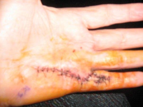 ONE WEEK LATER, SHOWING THE STITCHES.