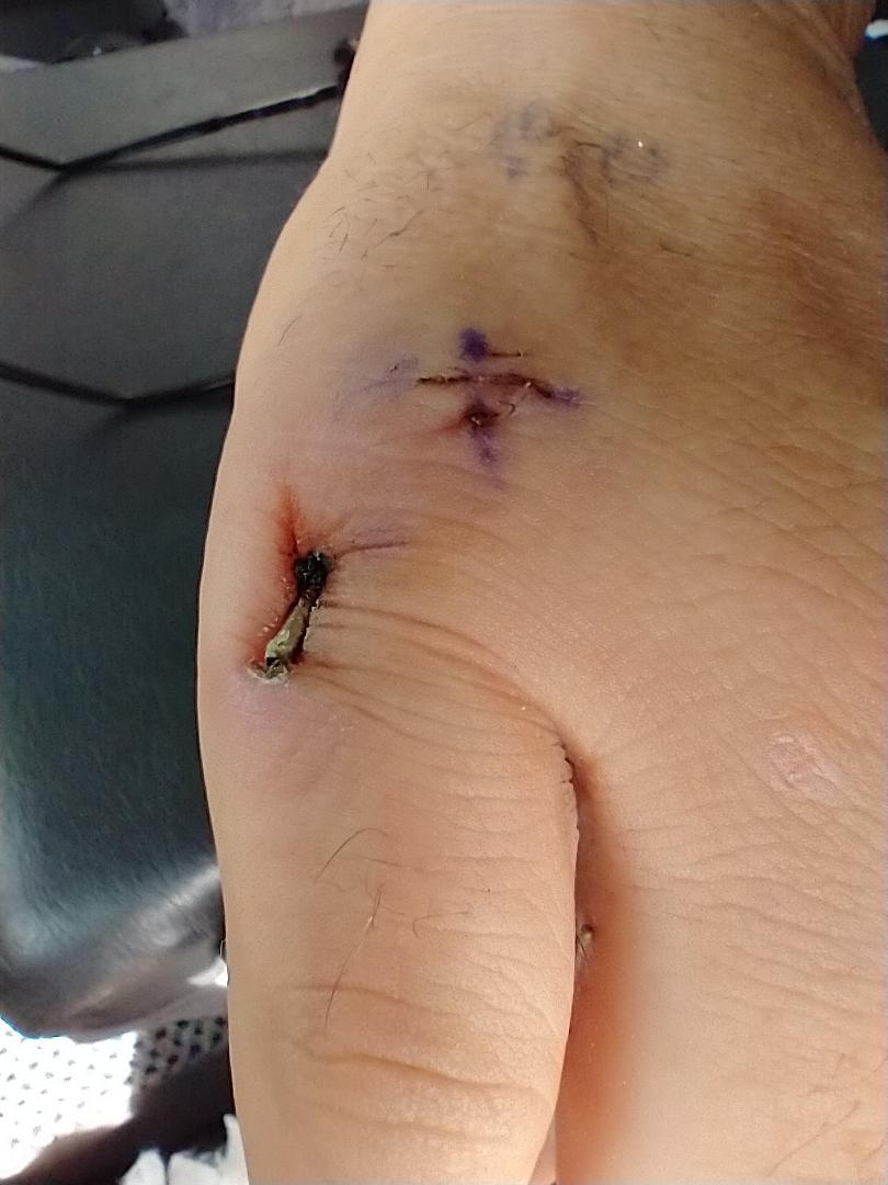 Sneaked a peek at the hand a week and a half after surgery. The staple in the knuckle hurts like hell I don't even feel the pins and plate in the hand.