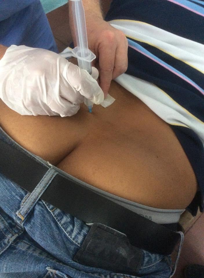 Marc injecting a sacral-iliac joint