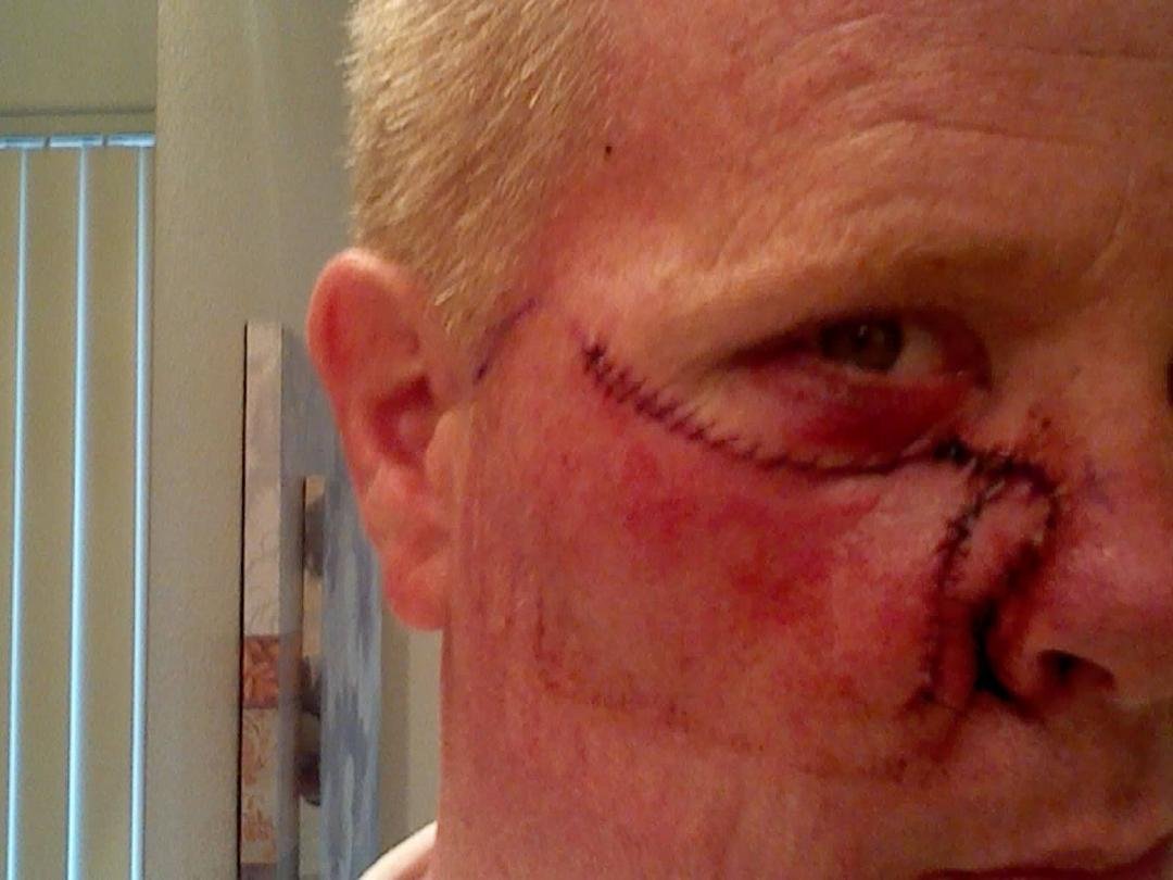 just had cancer removed from my nose and cheek