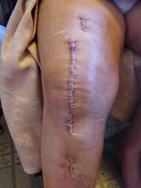 57 stitches and doing  ok they come out monday
