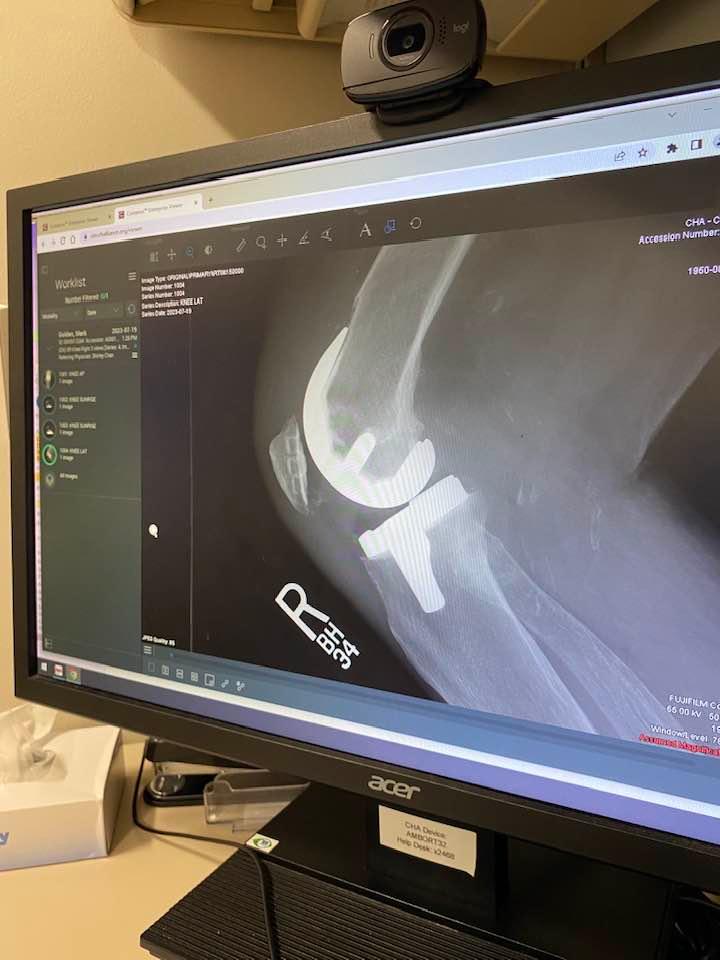 I got my knee replacement X Rayed today for an appointment with Orthopedics.
They installed ET in my knee! Now I have to phone home.