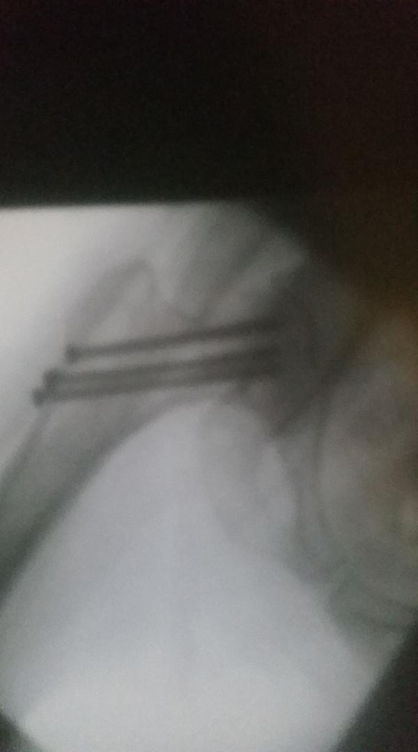 Charlene's hip