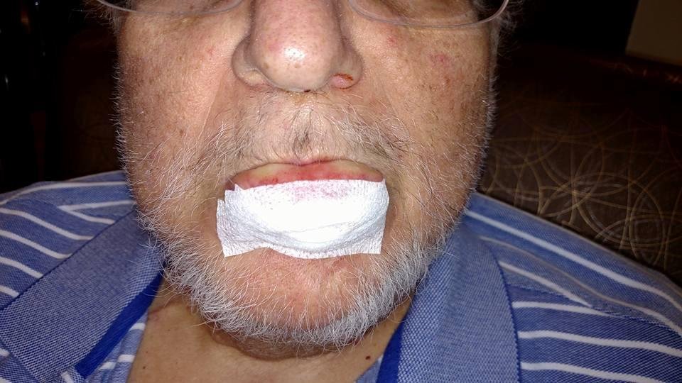 This is what happens if you talk back to your wife.  Actually, just me after having a small growth removed.  Now for chemo which makes this procedure a walk in the park.