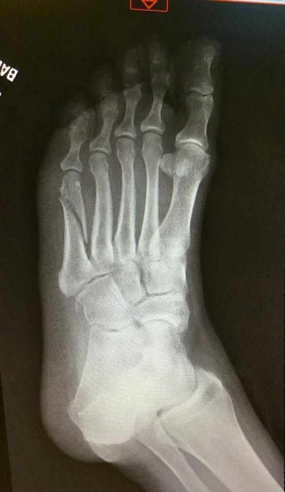 This is what a spiral fracture of the fifth metatarsal looks like. Apparently a very common fracture but not to me. Nothing common or fun about this. Pups here, dogs that need walking, cats down at the barn. Ugh. If th