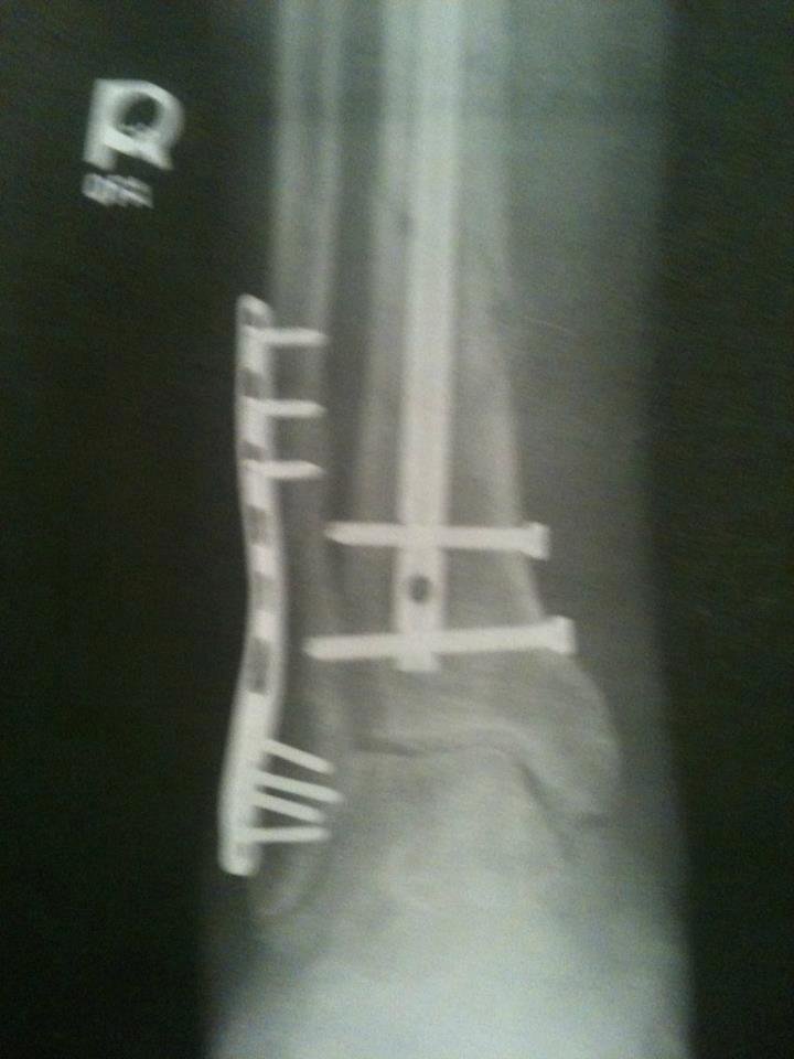 Right leg