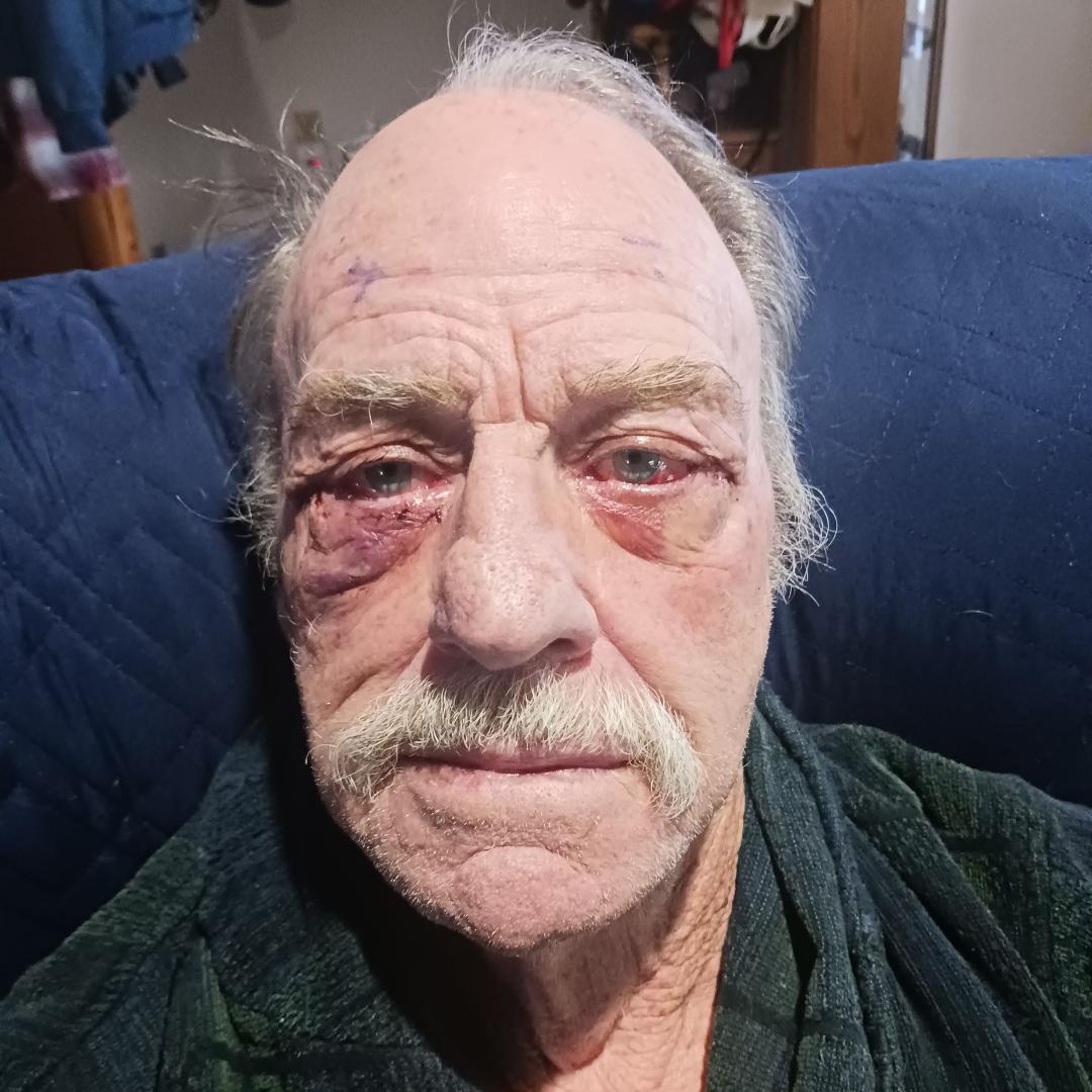 Day 2 after eye surgery .