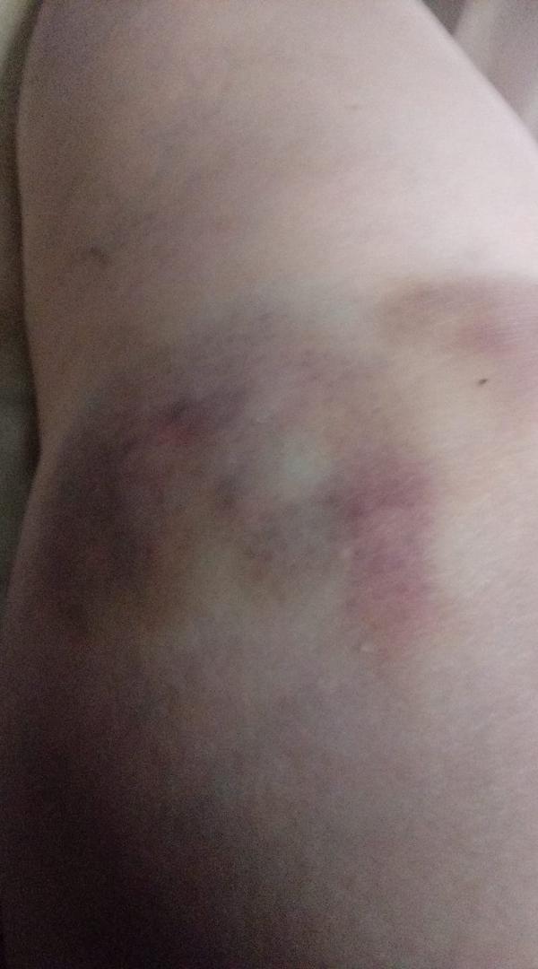 Two days after incident.