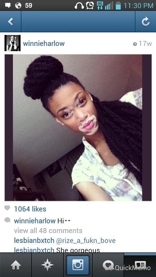 This woman has vitiligo, but regardless she is gorgeous.