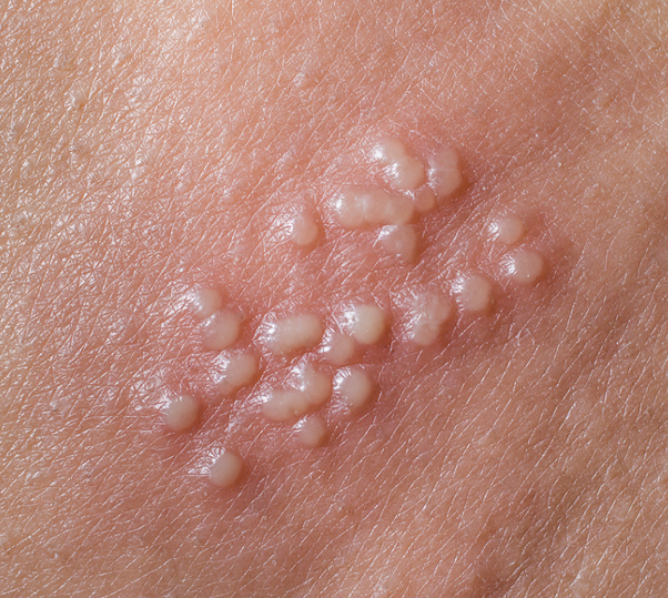 Herpes blisters