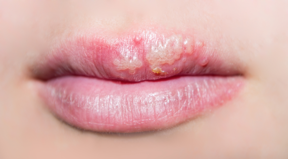 Close-up of cold sore