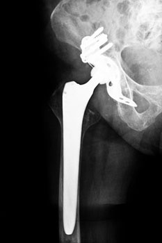 Hip Xray
