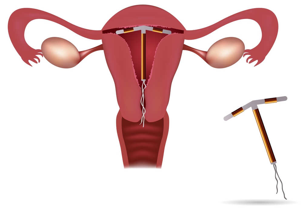 Diagram of an IUD in the uterus