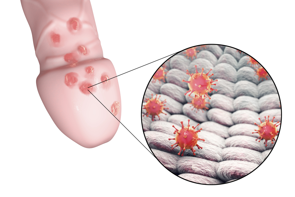 Animated diagrama of herpes on penis