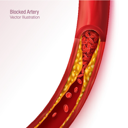 blocked artery picture