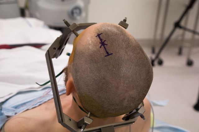 Deep brain stimulation - preparation